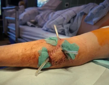 A close-up of an arm that was bitten by a dog and is now receiving medical attention, including sutures and disinfection.